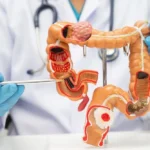 Kolon Kanseri Evreleri