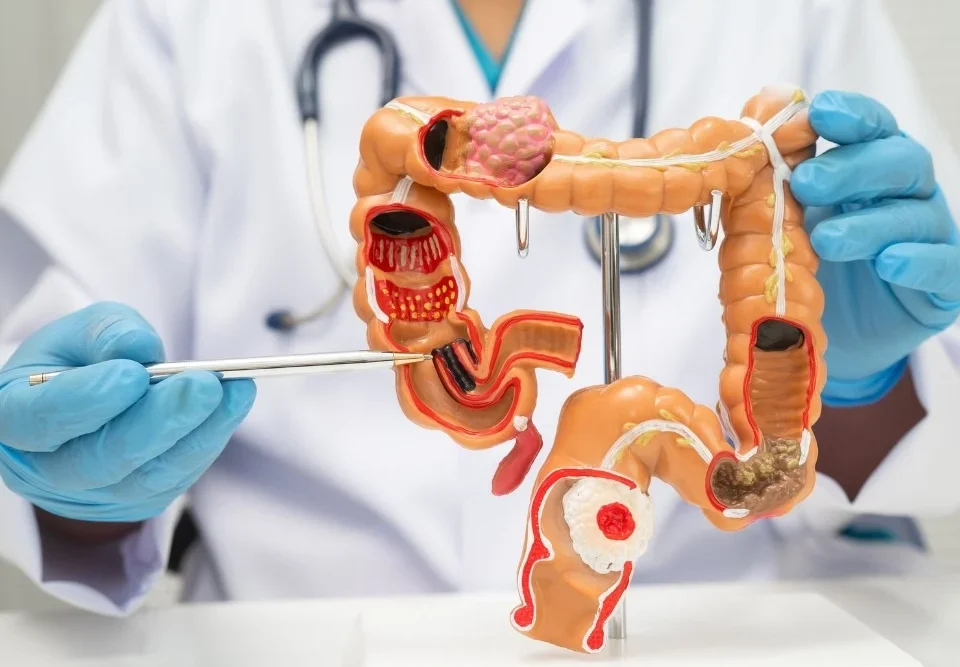 Kolon Kanseri Evreleri