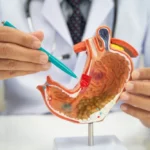 mide kanseri belirtileri